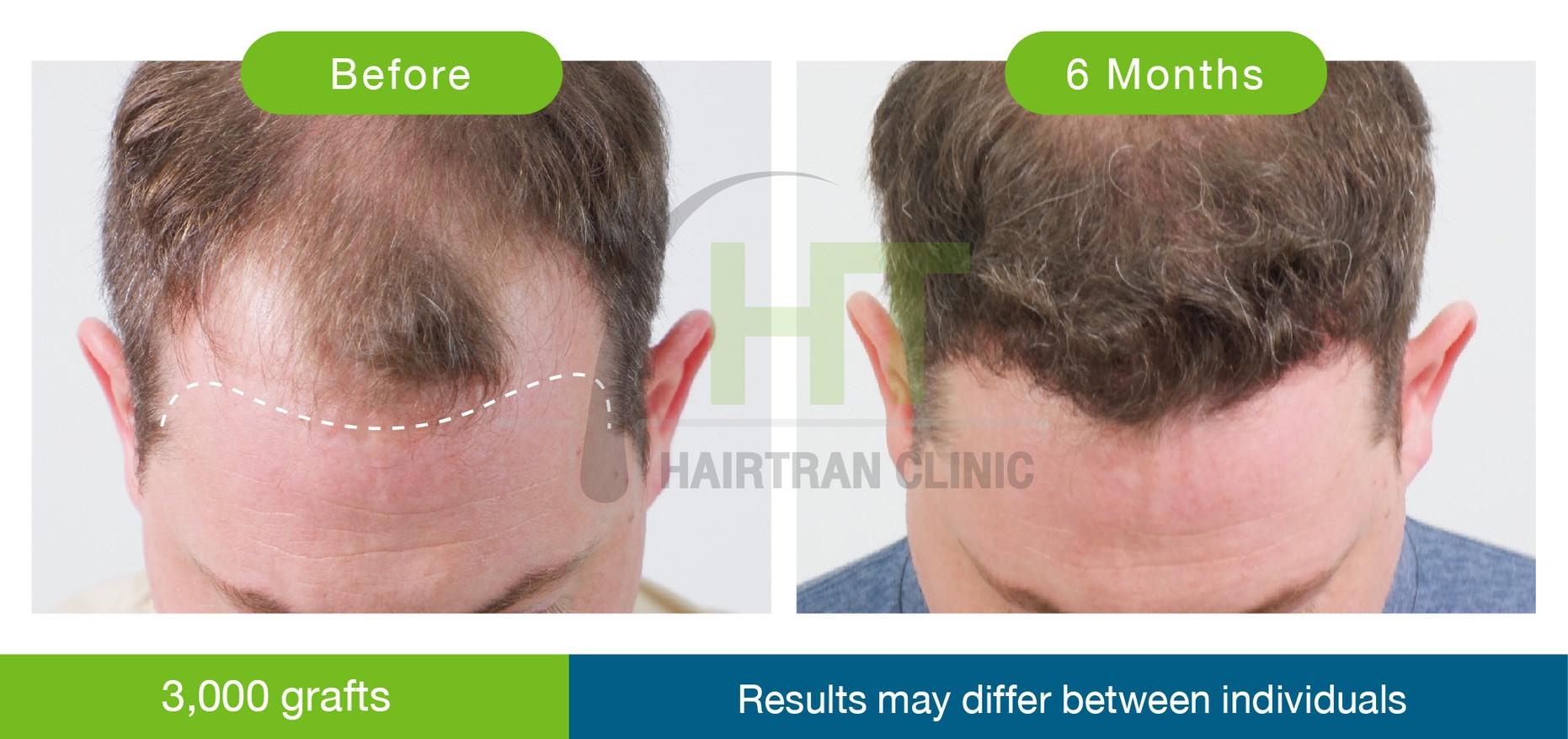 Taking hair growth medicine after a hair transplant  Hairtran Clinic
