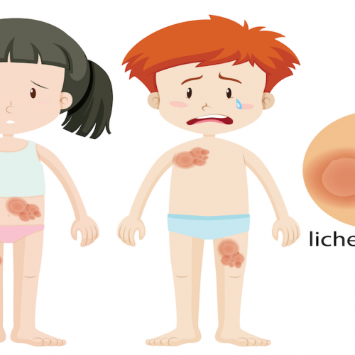 โรคไลเคนพลานัส (Lichen Planus) ส่งผลกระทบต่อเส้นผมและหนังศีรษะอย่างไร