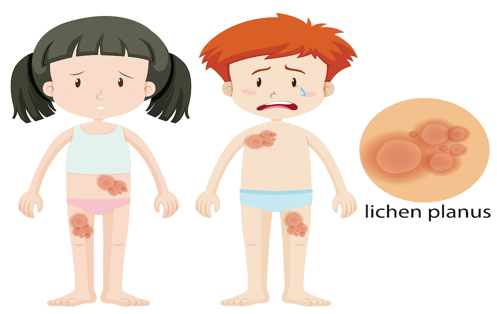 โรคไลเคนพลานัส (Lichen Planus) ส่งผลกระทบต่อเส้นผมและหนังศีรษะอย่างไร