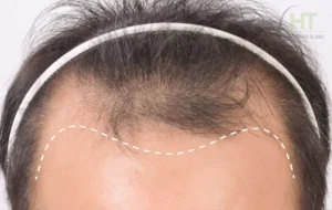 ประเมินกราฟท์ปลูกผม