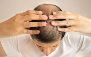 อายุน้อย หัวล้าน