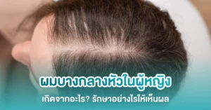 ผมบางกลางหัวผู้หญิง
