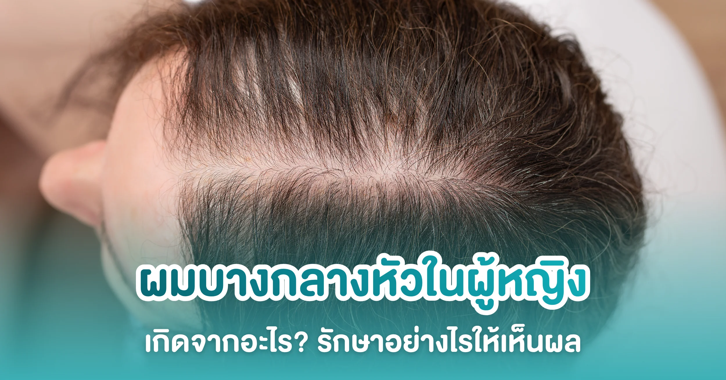ผมบางกลางหัวผู้หญิง เกิดจากอะไร? รักษาอย่างไรให้เห็นผล