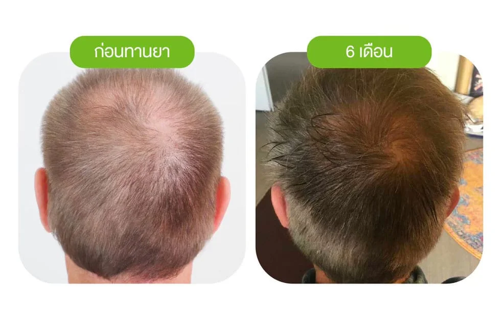 รีวิวปลูกผม