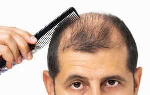 หวีผมแล้วผมร่วง