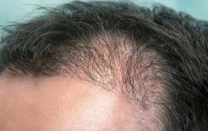 ปลูกผม ผมหยิก