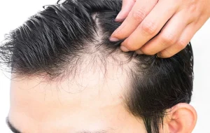 ผมร่วง ผมบาง