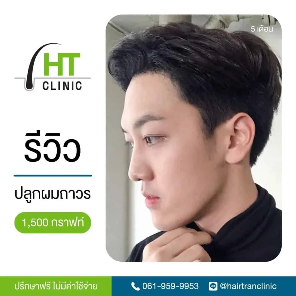 รีวิวปลูกผม คุณแบงค์