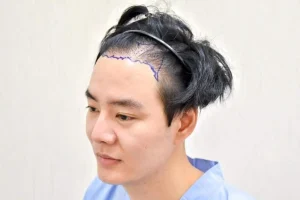 ปลูกผมถาวร