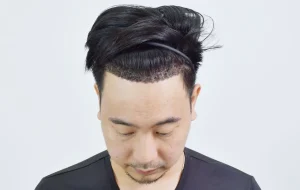 อาการคันหลังปลูกผม