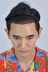 อาการหลังปลูกผม
