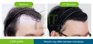 รีวิวปลูกผมมุมข้าง