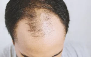 สัญญาณหัวล้าน