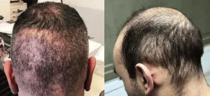 ราคาปลูกผม