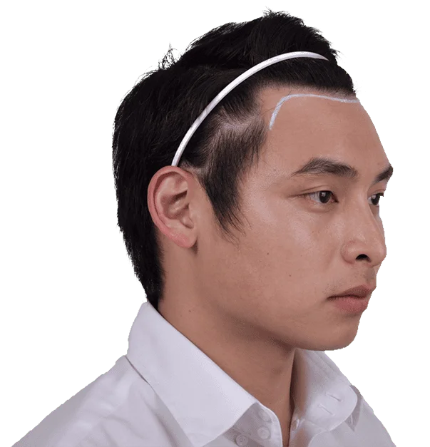 Hair Transplant