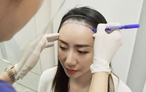 ปลูกผมปรับกรอบหน้า