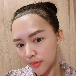 ผมแห้งหลังปลูกผม