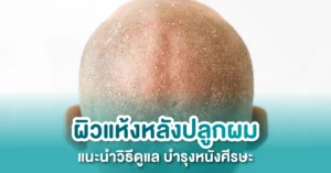 ผมแห้งหลังปลูกผม ปลูกผมแล้วผมแห้ง