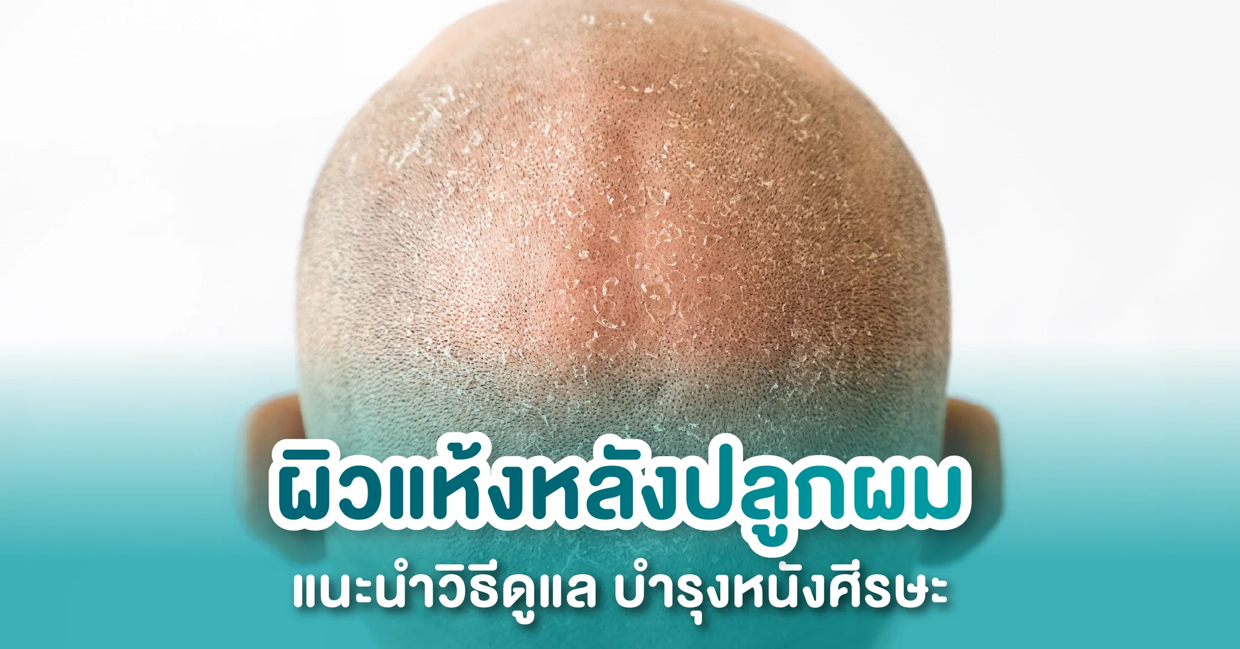อาการผิวแห้งหลังปลูกผม คันบริเวณหนังศีรษะ เกิดจากอะไร?
