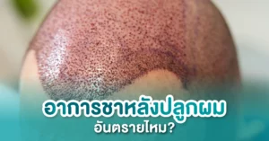 อาการชาหลังปลูกผม
