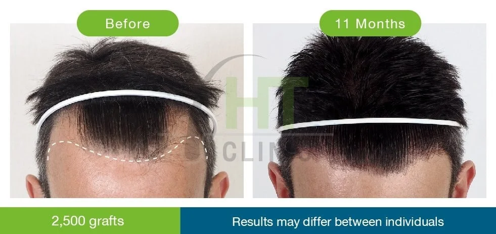 Front Hair Transplant - Before & After