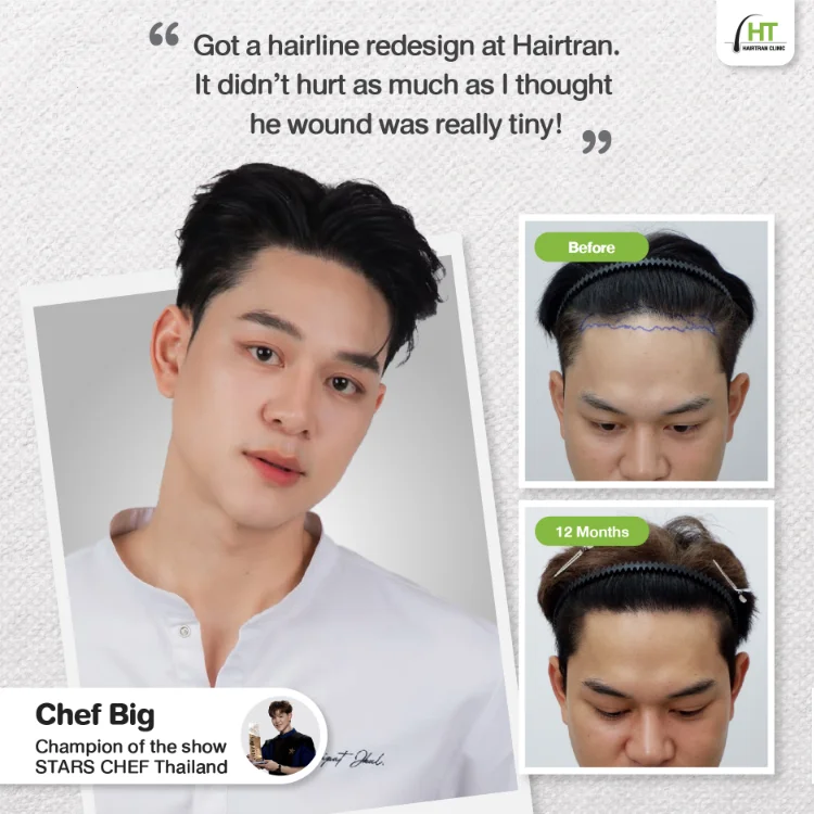Hairtran Clinic influencer