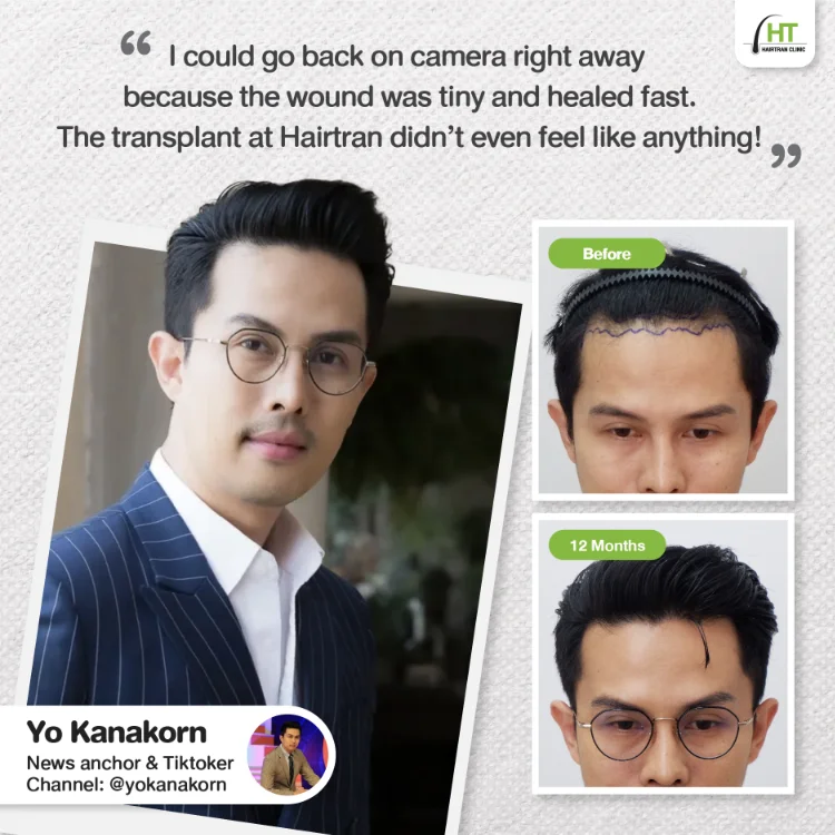 Hairtran Clinic influencer
