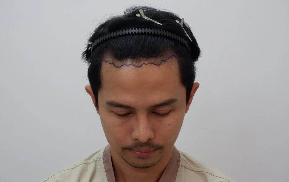 รีวิวปลูกผมคุณโย