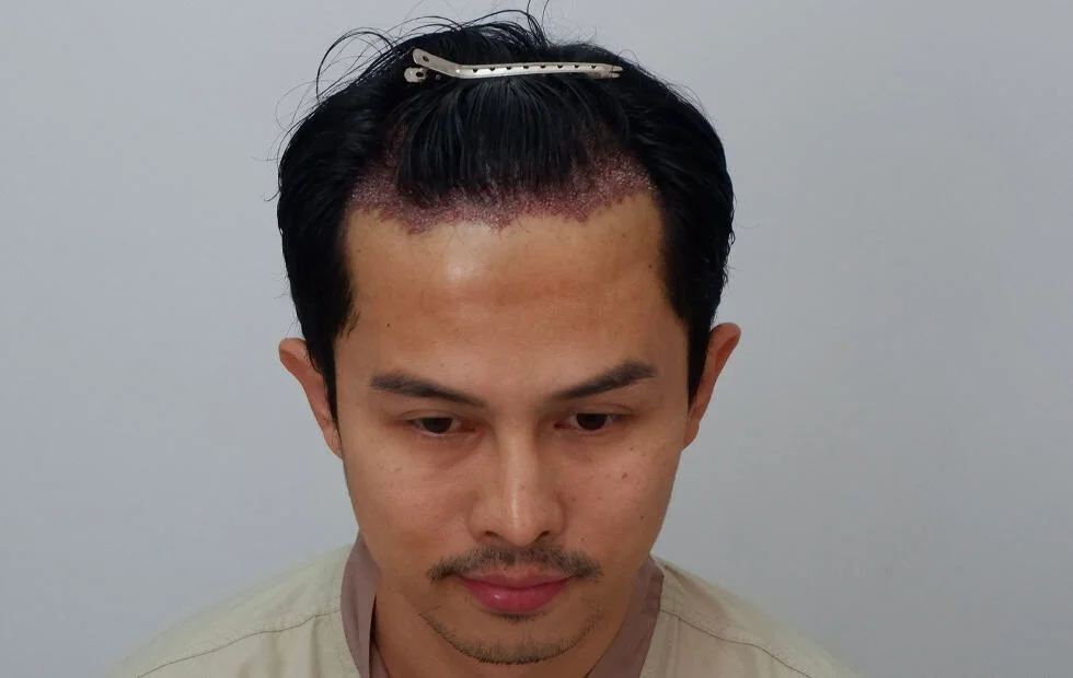 โย รีวิวปลูกผม