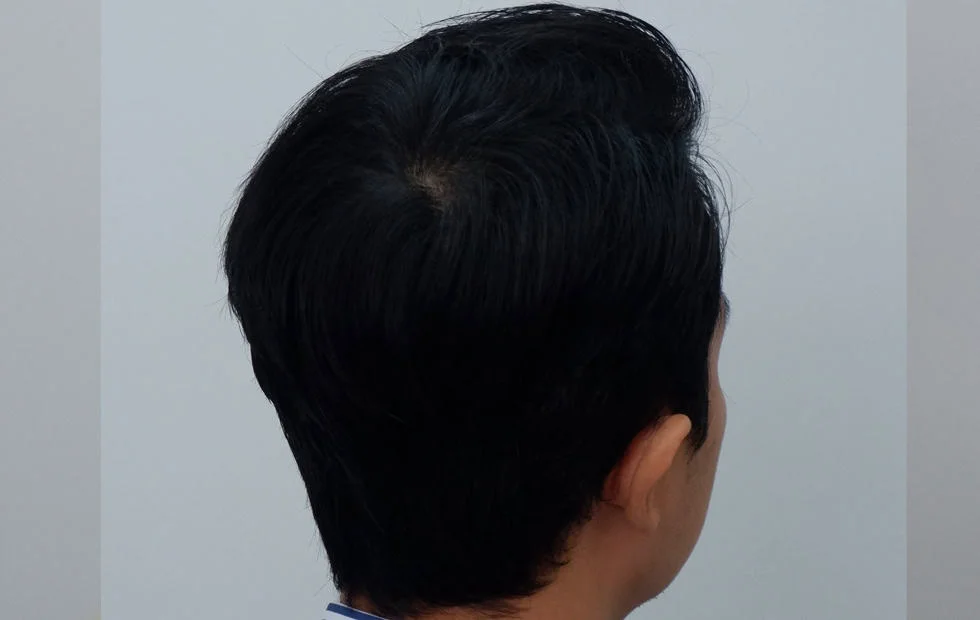 คุณโยปลูกผม