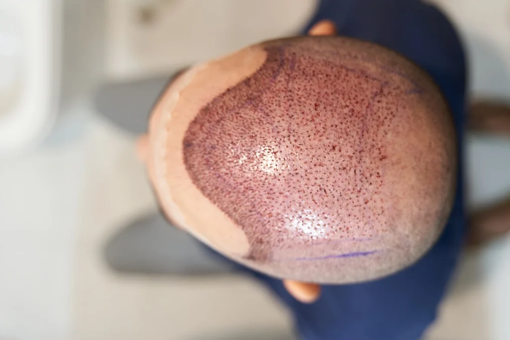 หลังปลูกผม ชา กาแฟ ทำให้แผลมีการฟื้นตัวช้าลง