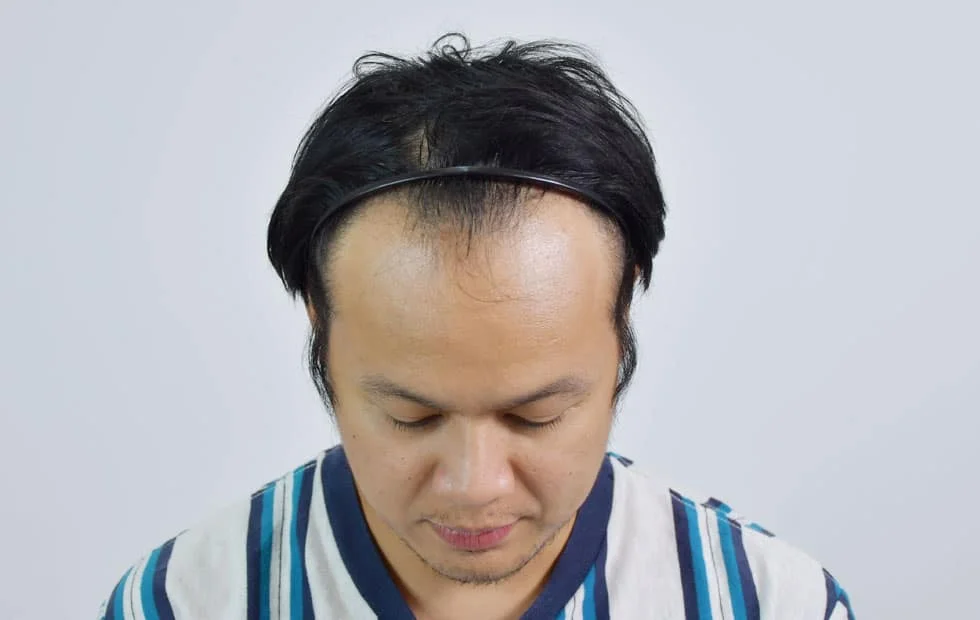 รีวิวปลูกผม คุณ Gun