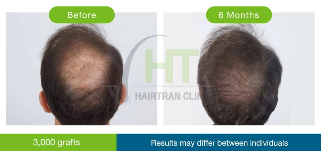 hair transplant result