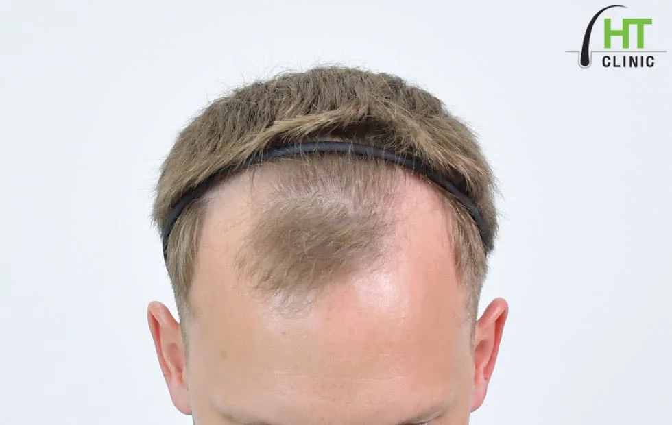 Hair transplant in Caucasian