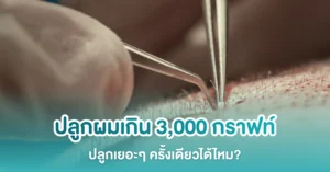 ปลูกผม 3,000 กราฟท์