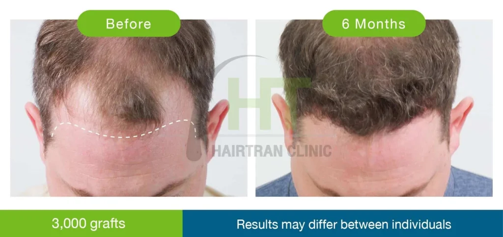 hair transplant result