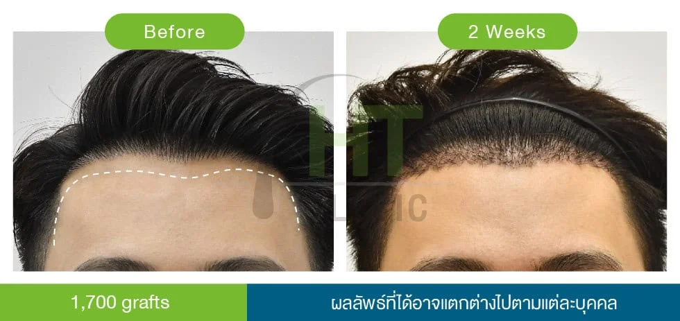 hair transplant result