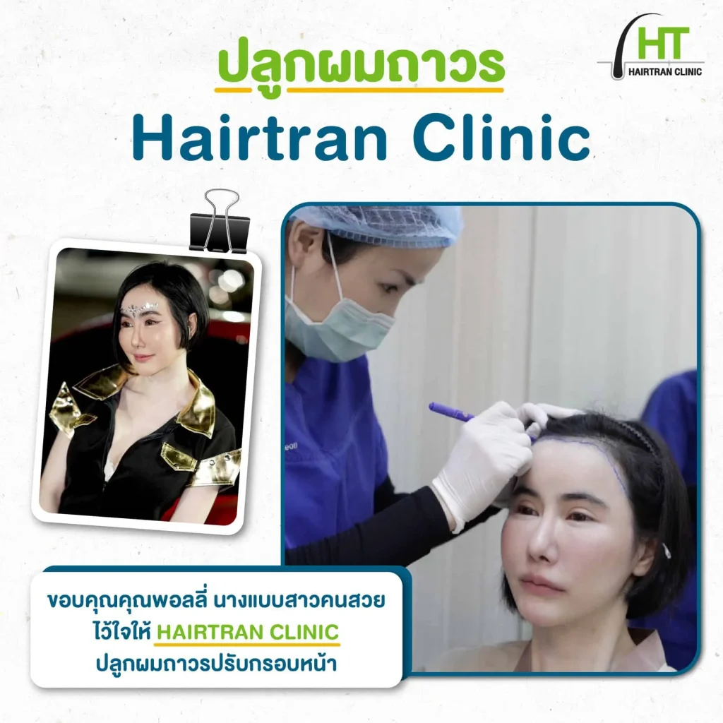 รีวิวปลูกผม คุณพอลลี่