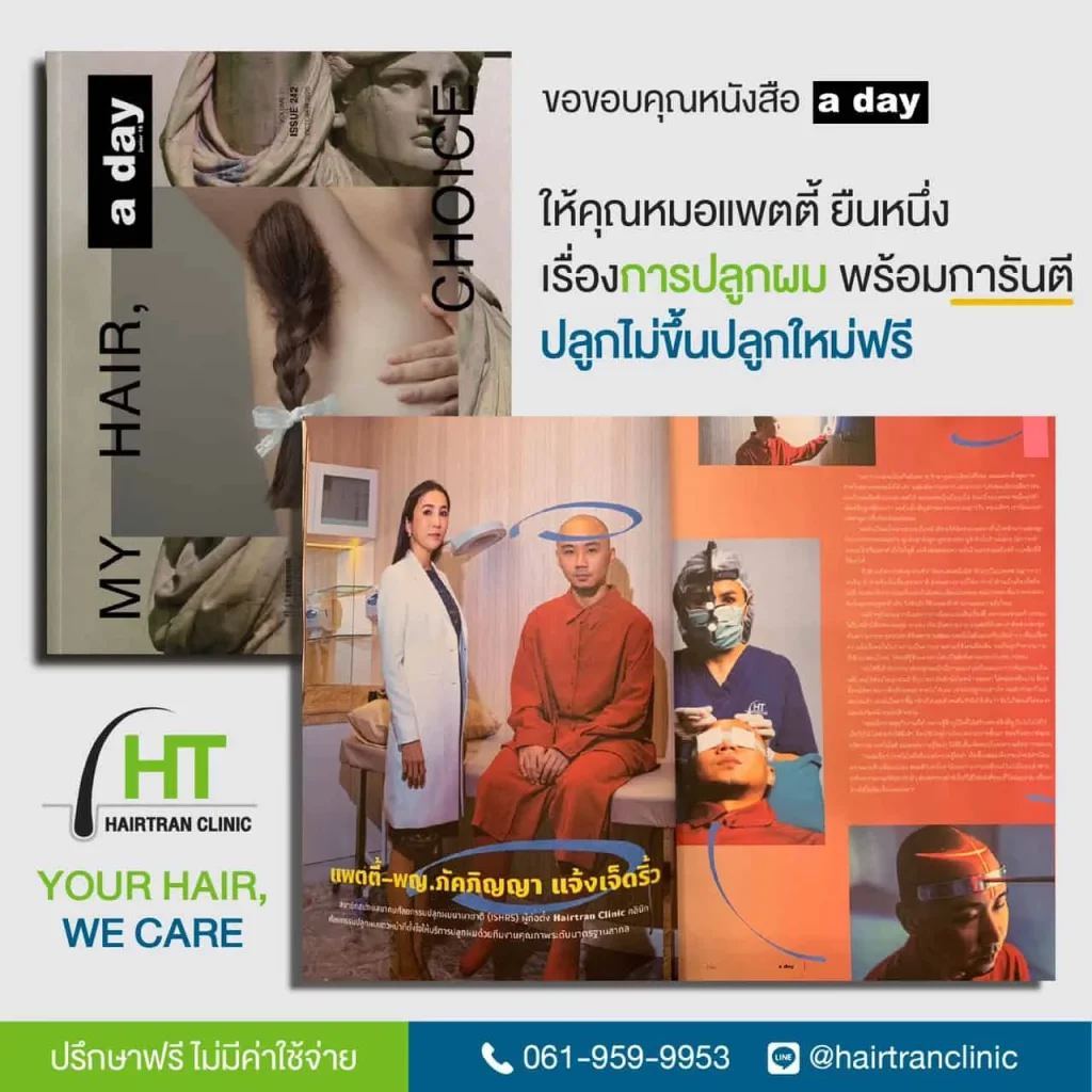 รีวิวปลูกผมถาวร