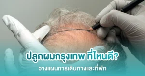 วางแผนปลูกผมกรุงเทพ