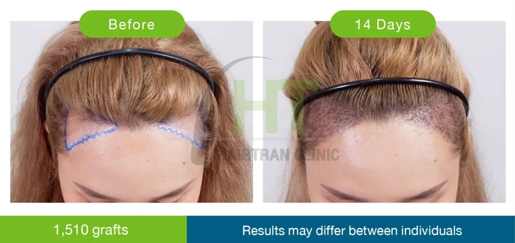 รีวิว Non-Shaven FUE ปลูกผมแบบไม่โกน