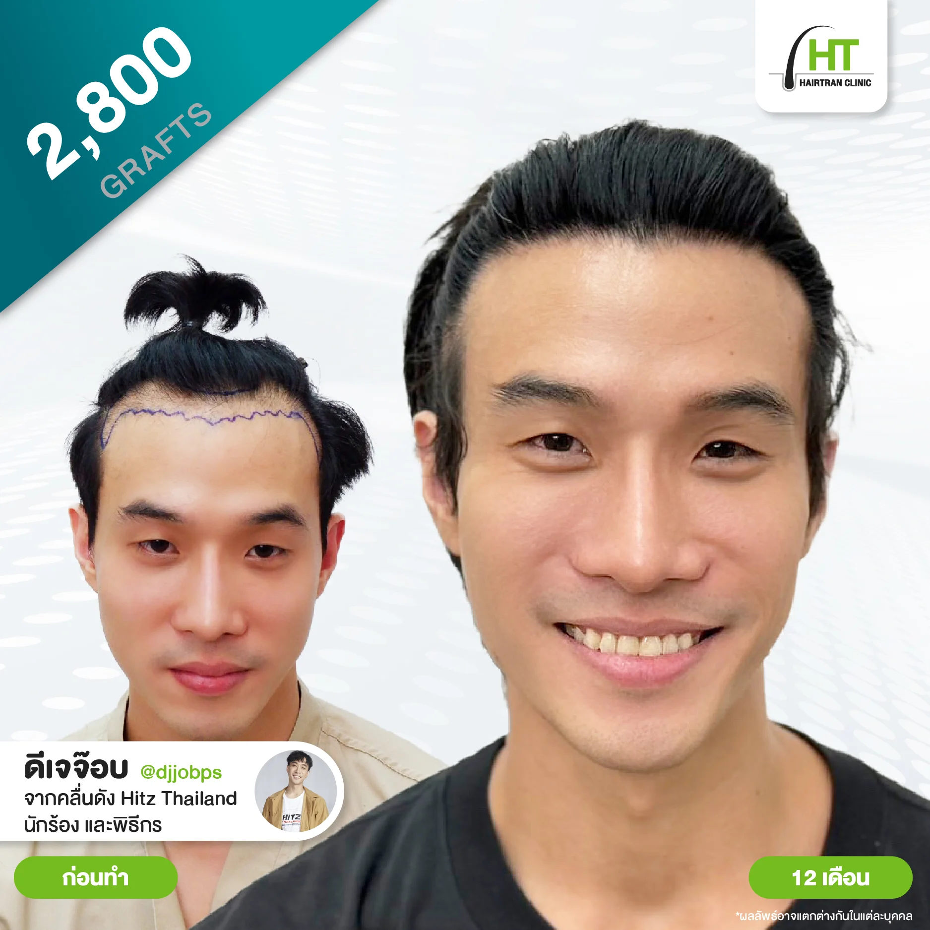 รีวิวปลูกผม DJ จ๊อบ