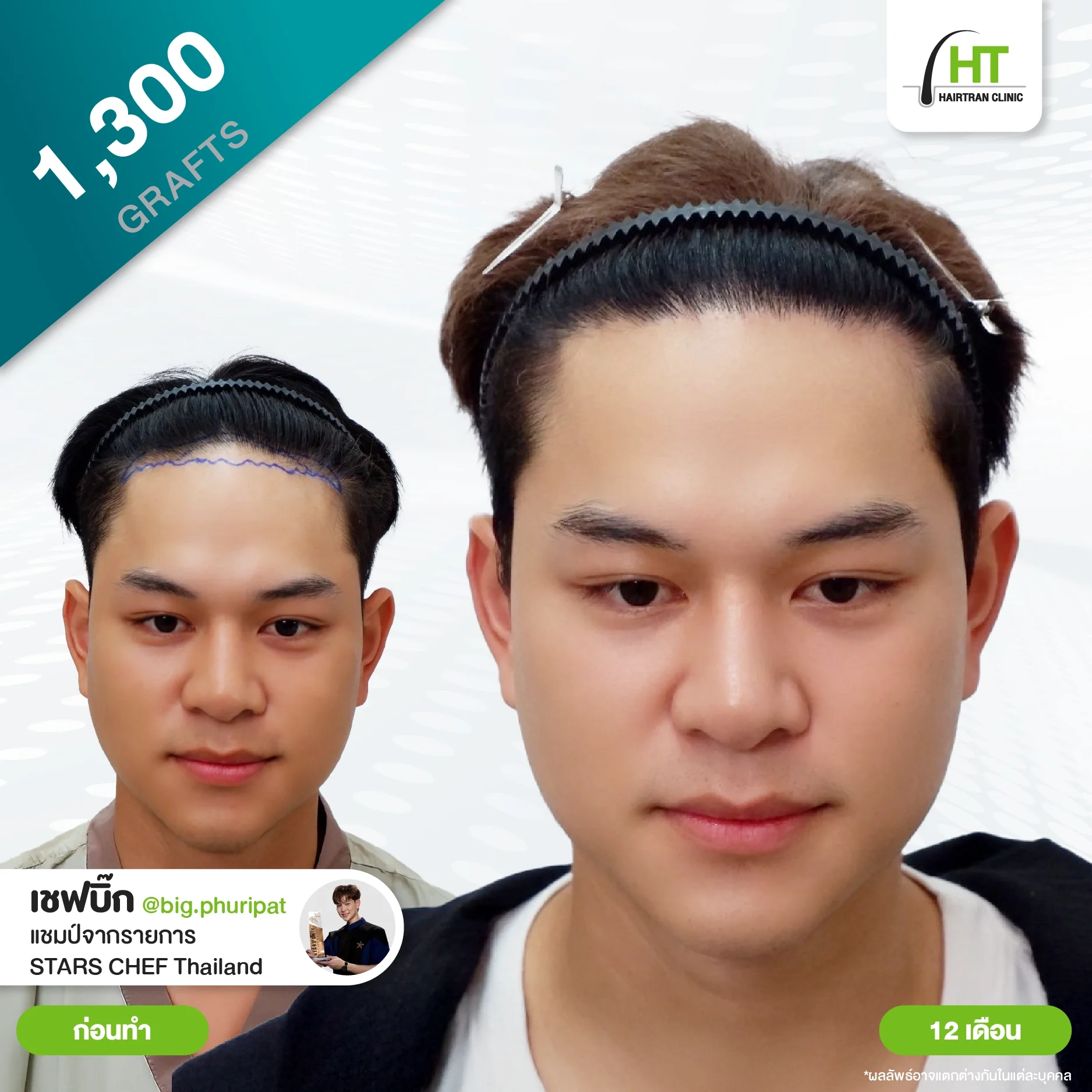 รีวิวปลูกผม เชฟบิ๊ก