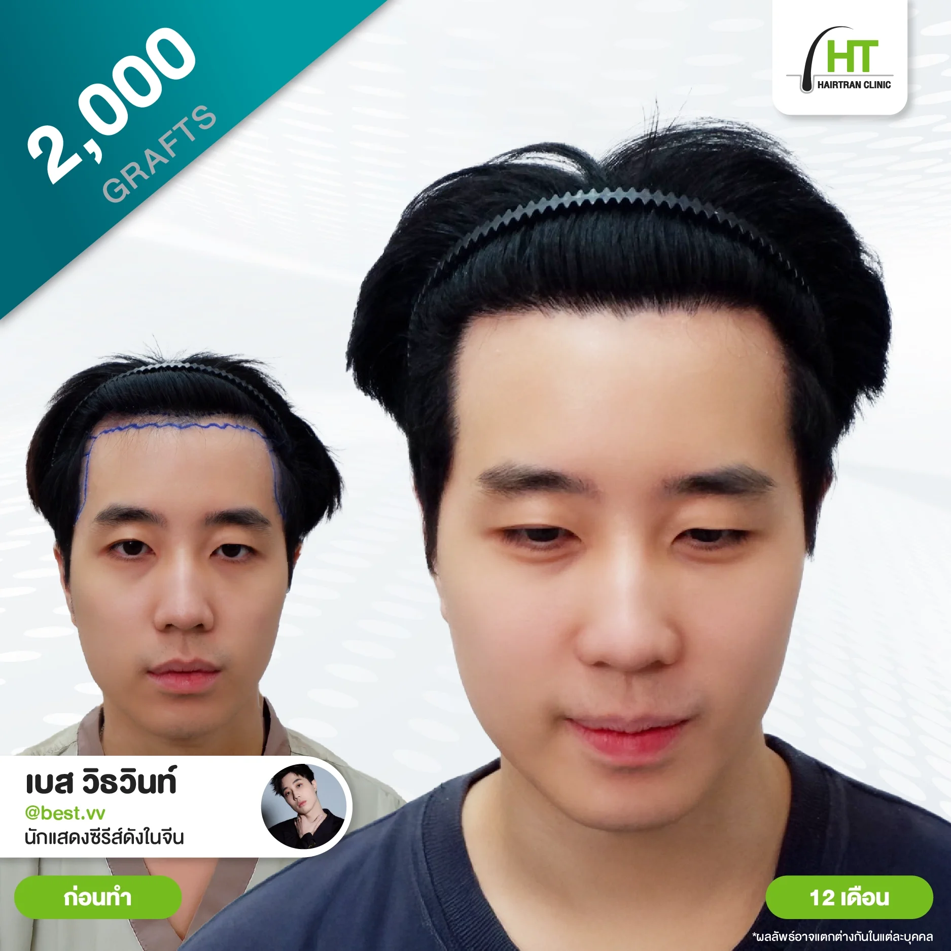 รีวิวปลูกผม คุณเบส