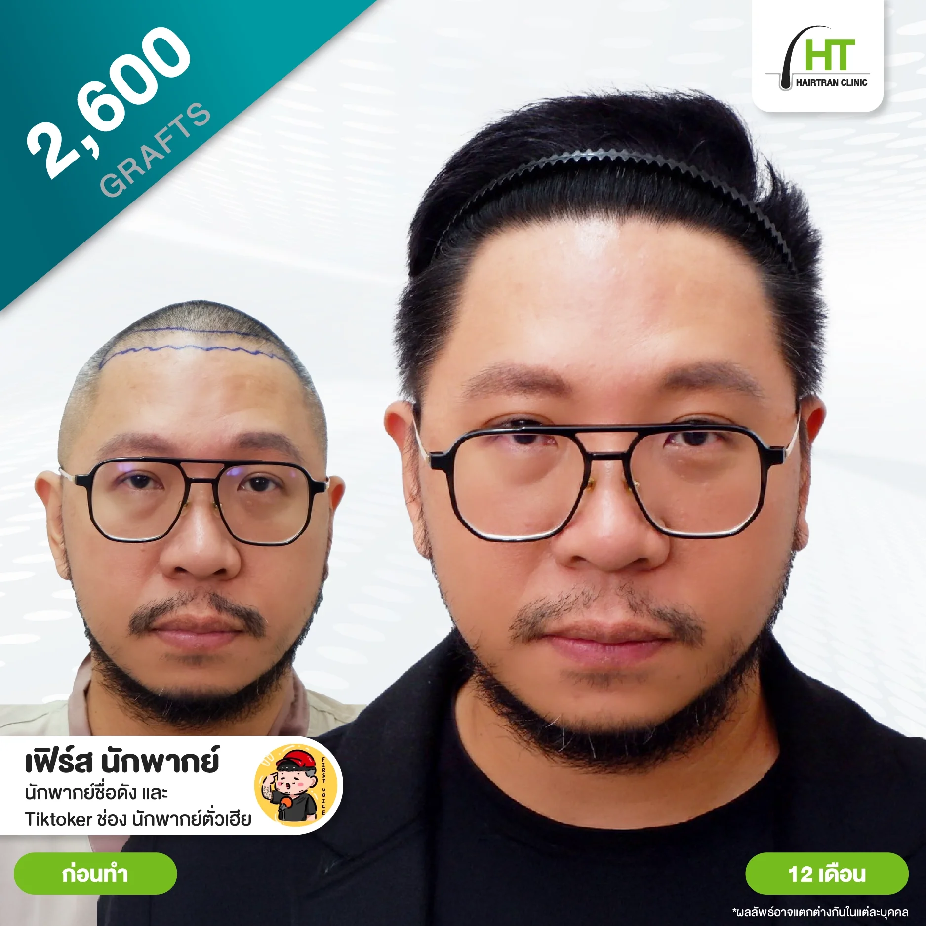 รีวิวปลูกผม คุณเฟิร์ส