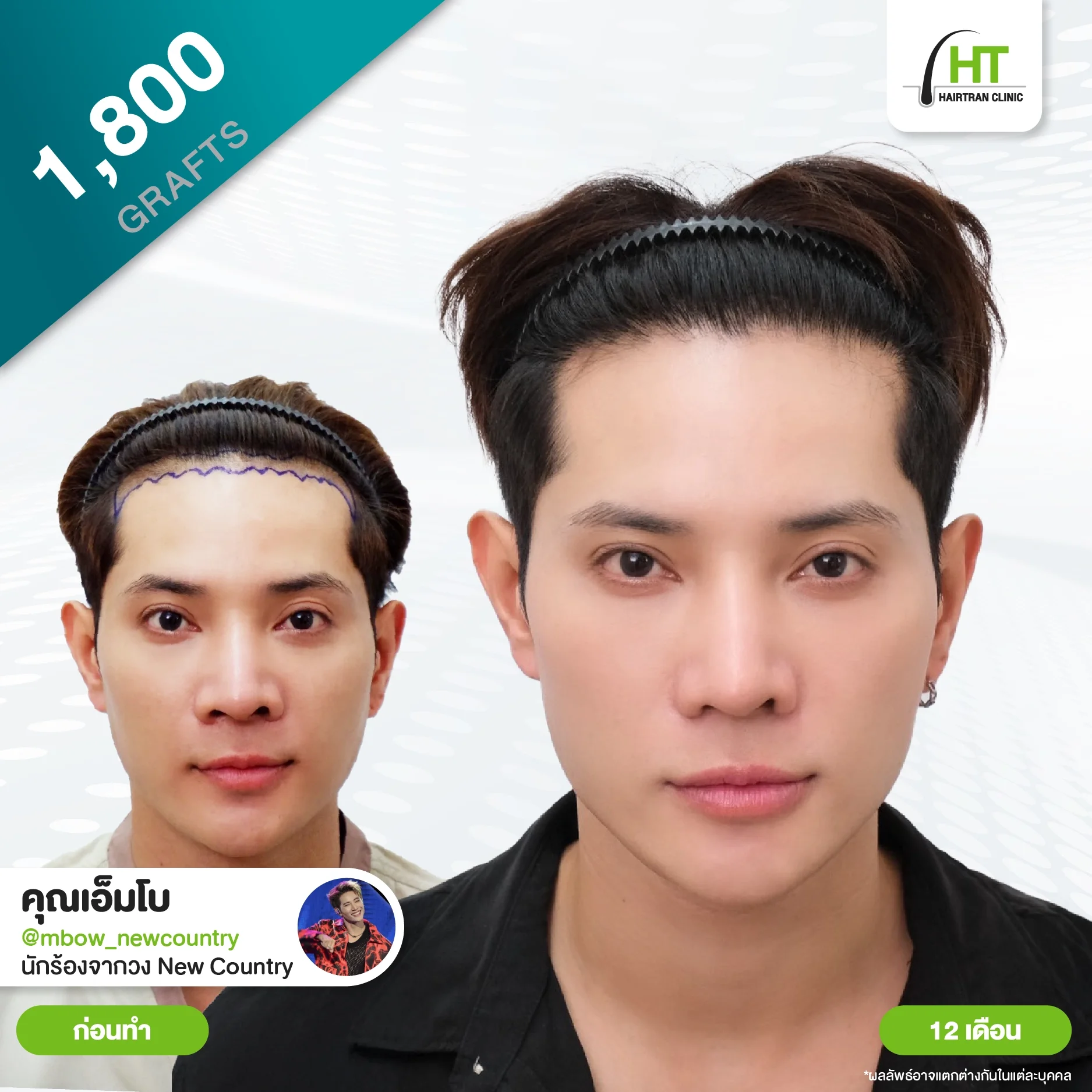 รีวิวปลูกผม คุณเอ็มโบ