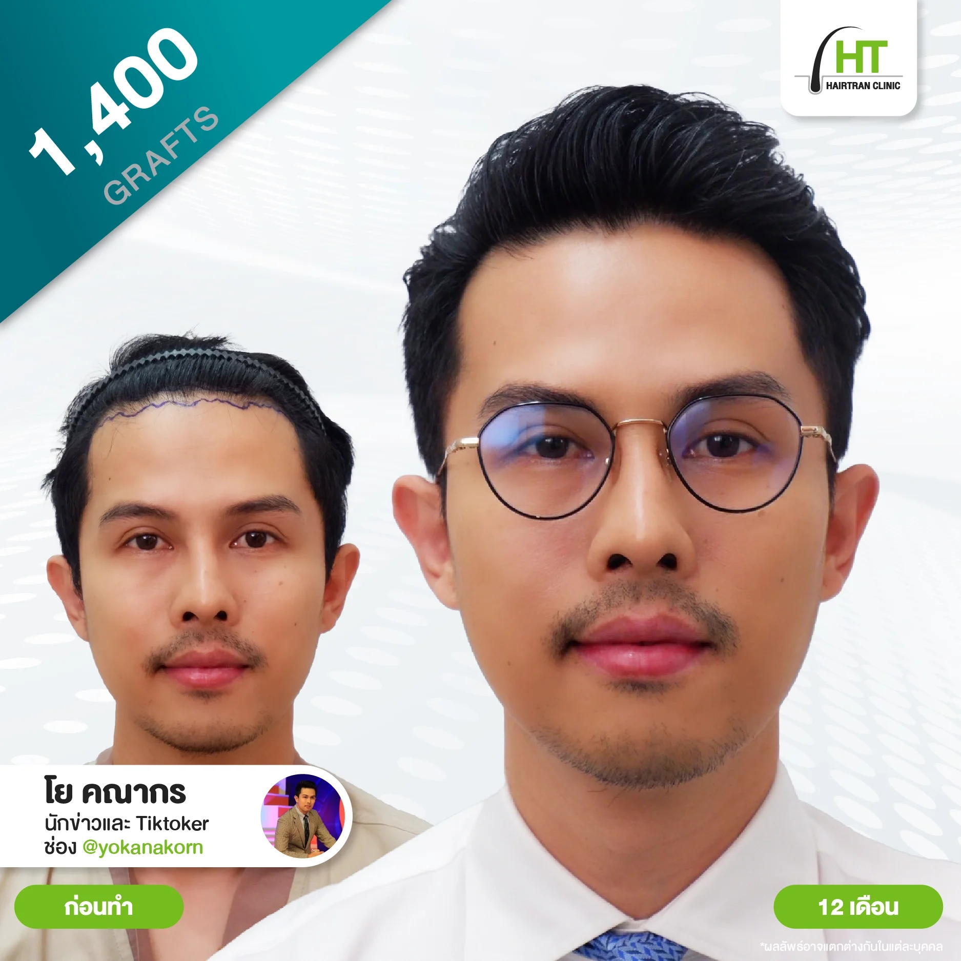 รีวิวปลูกผม คุณโย