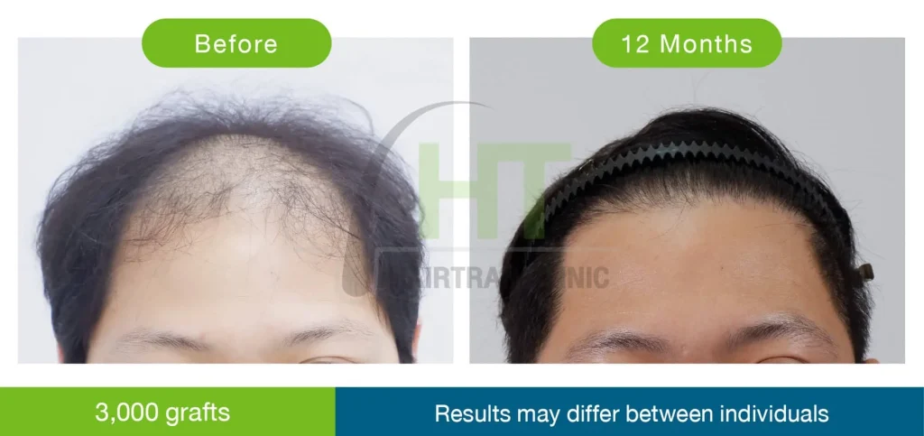 รีวิวปลูกผมผู้ชาย 12 เดือน