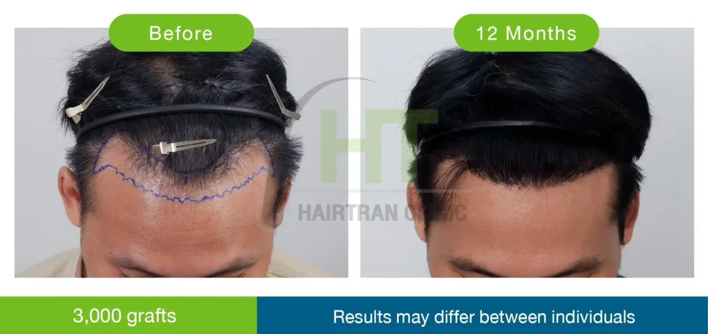 รีวิวปลูกผมผู้ชาย 12 เดือน
