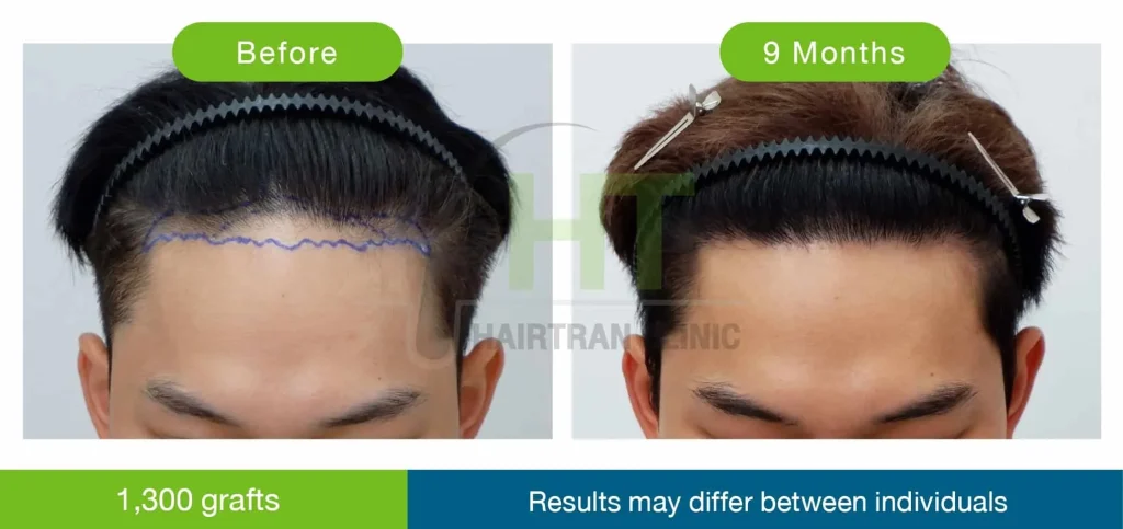 รีวิวปลูกผมผู้ชาย 9 เดือน